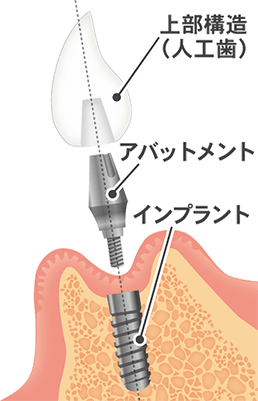 インプラントの構造 高槻の歯医者